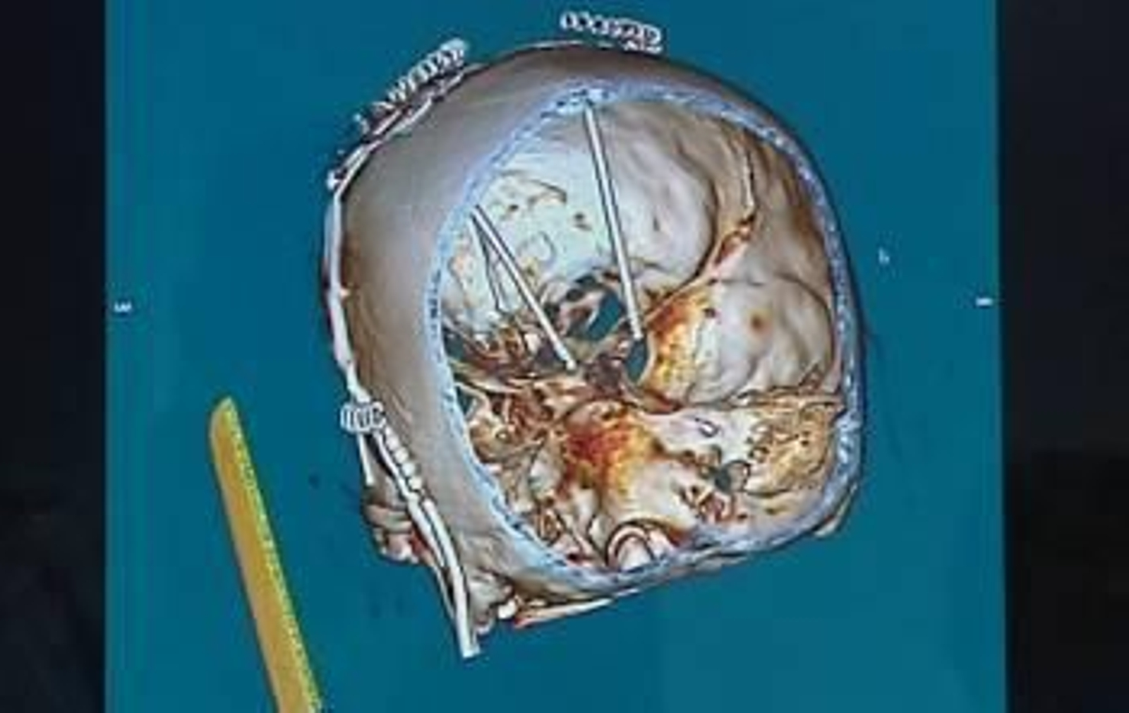 Imagen tomada de televisión que muestra la técnica desarrollada en el Hospital La Fe de Valencia por la que se ha sometido a un hombre afectado por un Trastorno Obsesivo Compulsivo (TOC) a una psicocirugía, una intervención que, mediante la introducción d