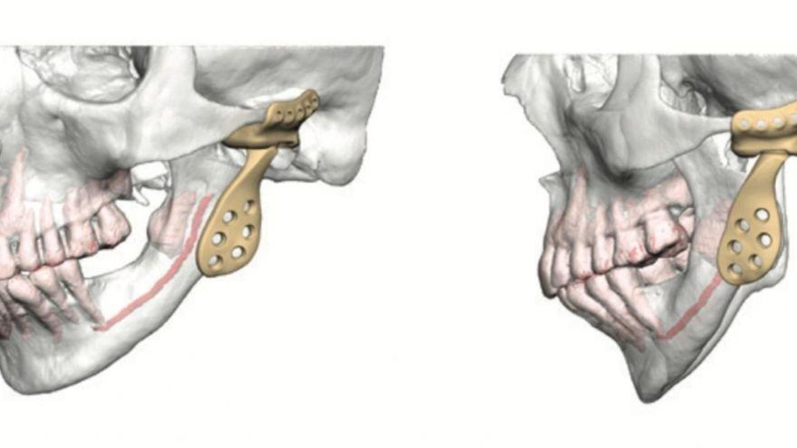 Una imagen de la prótesis de mandíbula.