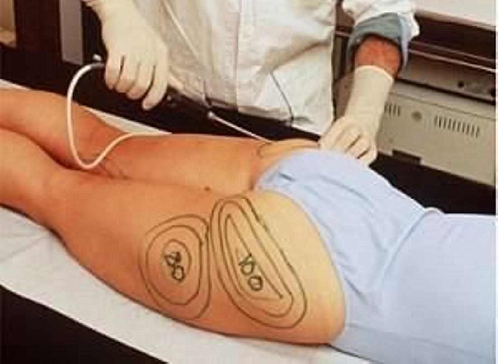 Una mujer se somete a una operación de cirugía estética.