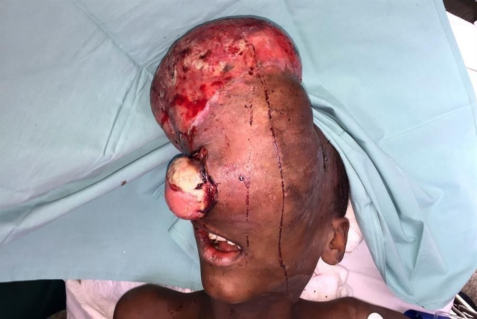 El niño con el tumor gigante.