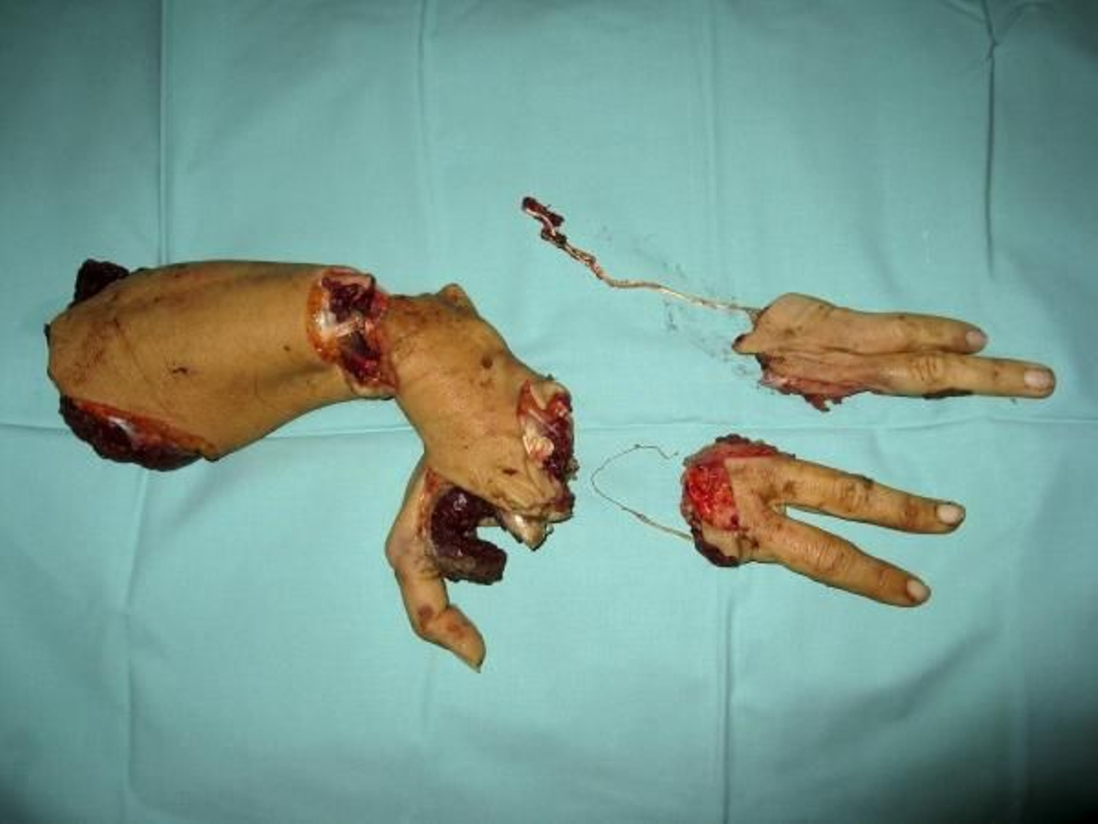 Estado del brazo tras un accidente laboral.