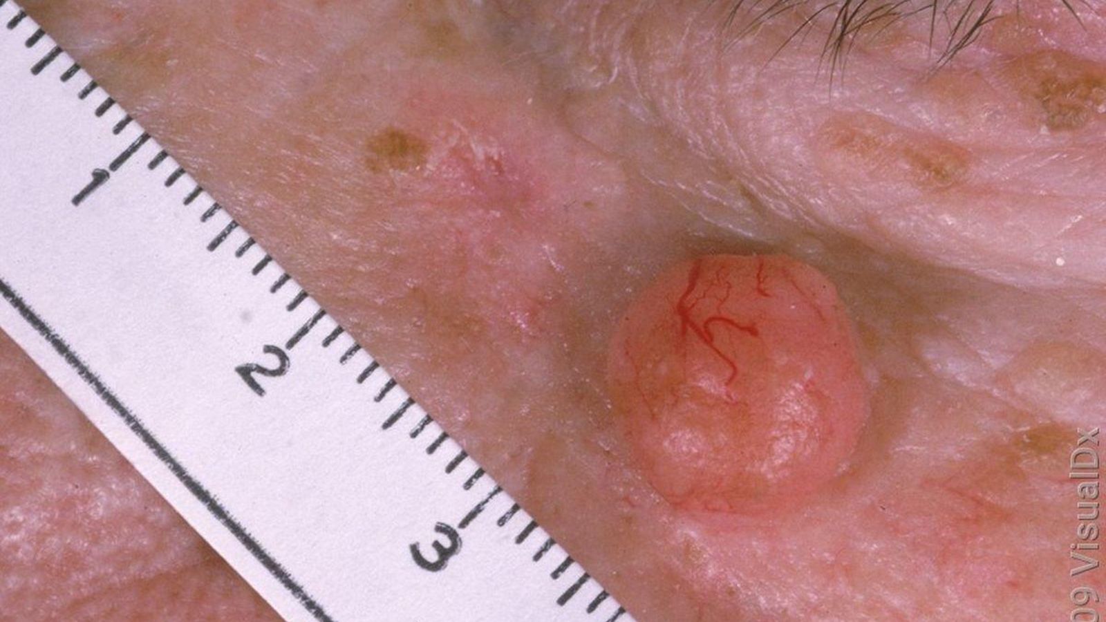 Carcinoma basocelular.