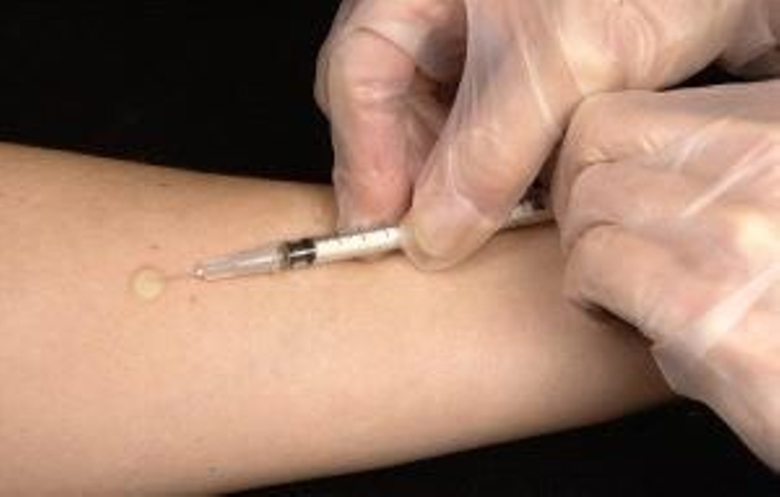 Más de 1.100 casos de tuberculosis aparecen cada año en Madrid.