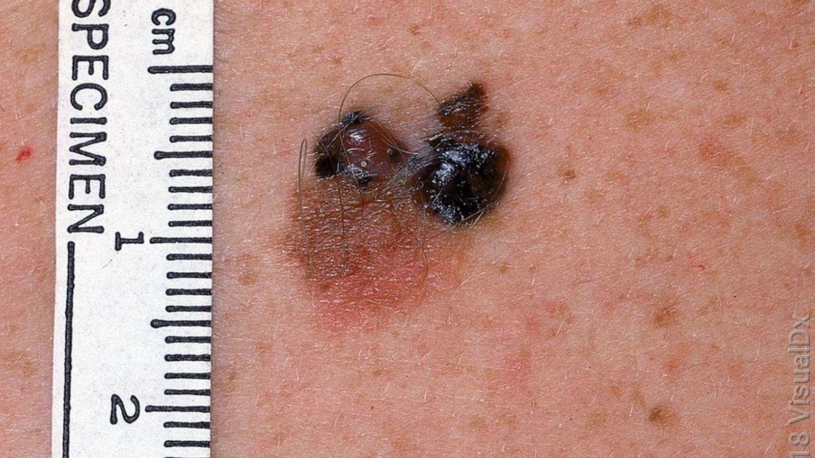 Melanoma.