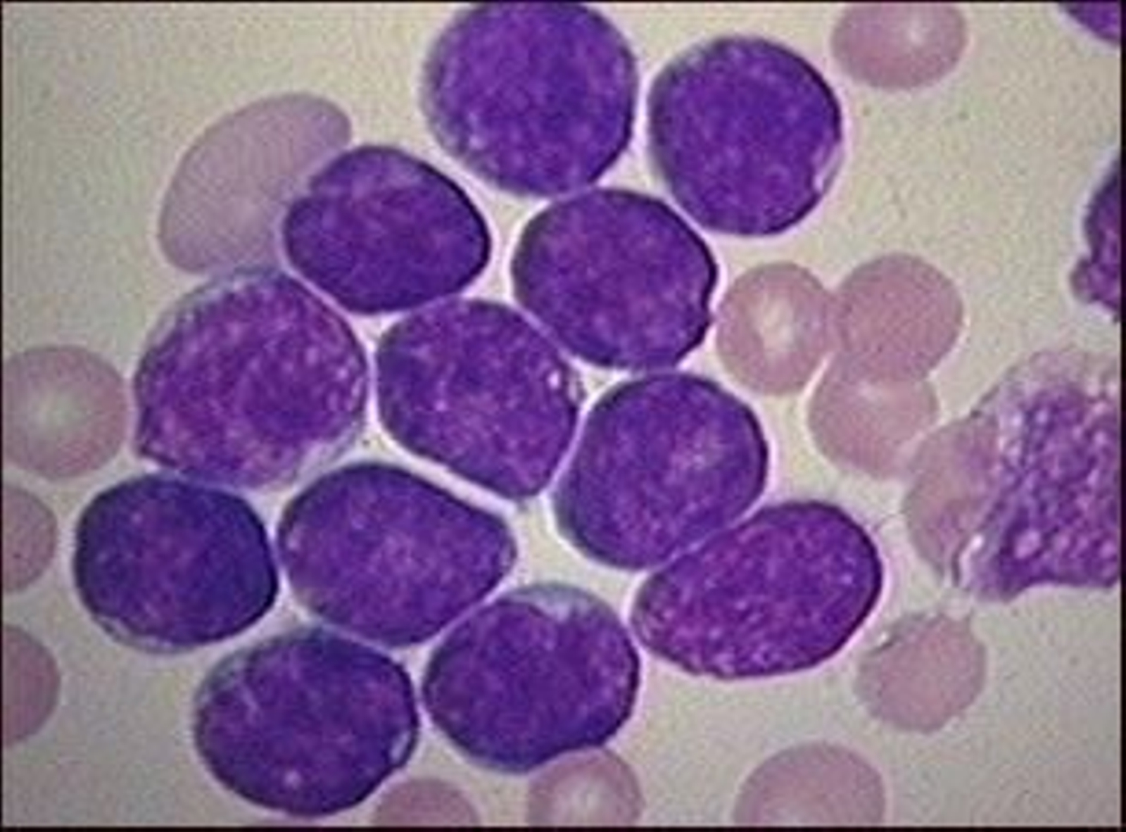 La leucemia, un poco más cerca de su erradicación.