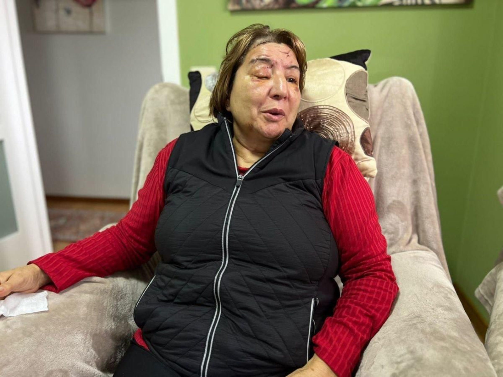 Carmen todavía tiene las marcas de la brutal agresión.