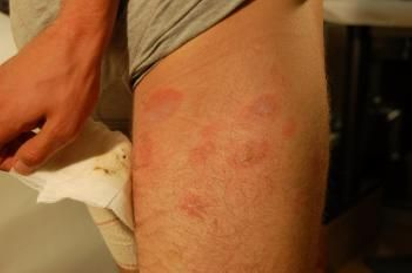 Algunas de las quemaduras que presentaba la víctima.