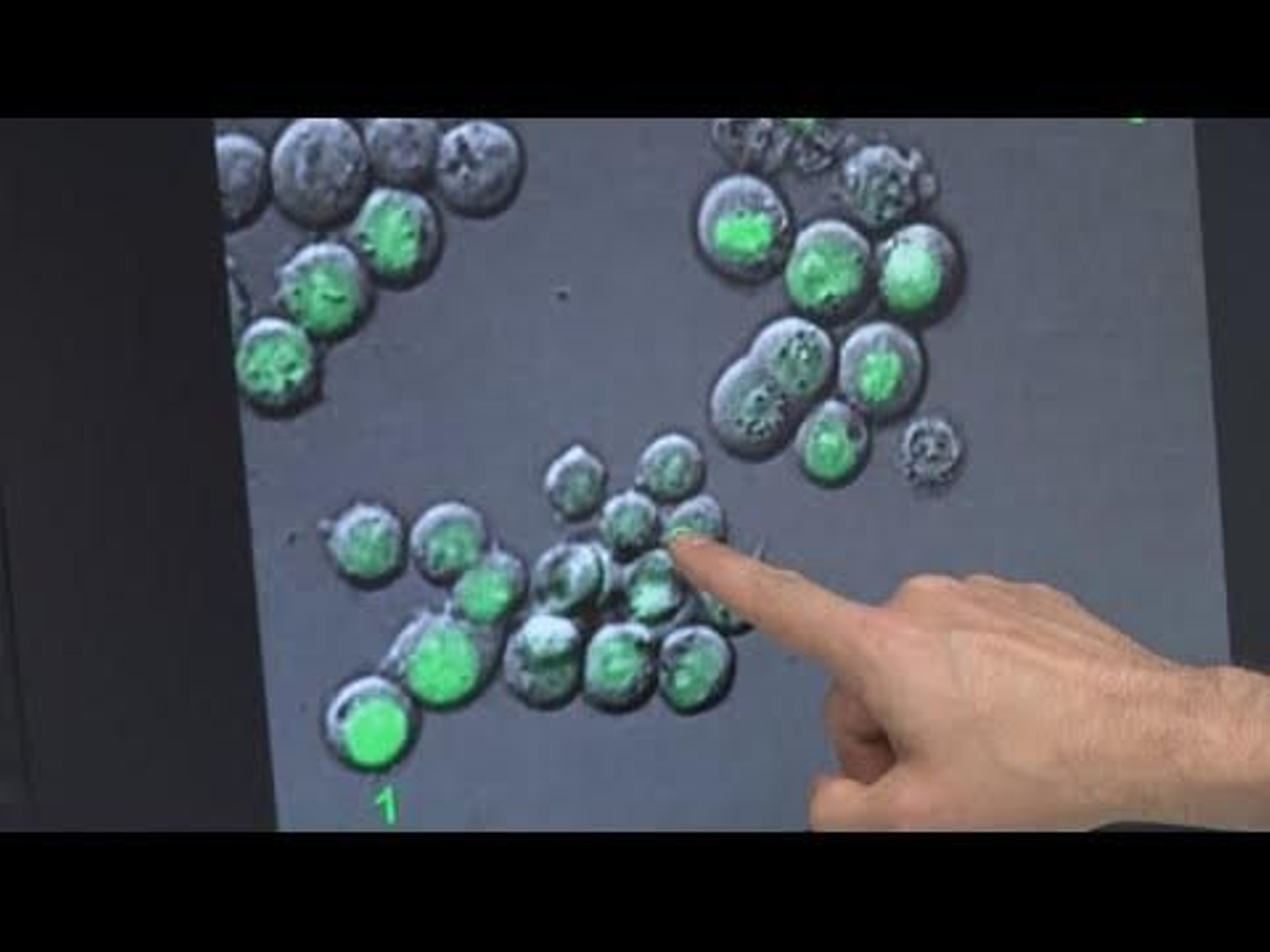 Descubren 'punto débil' de las células tumorales causantes de recaídas del cáncer